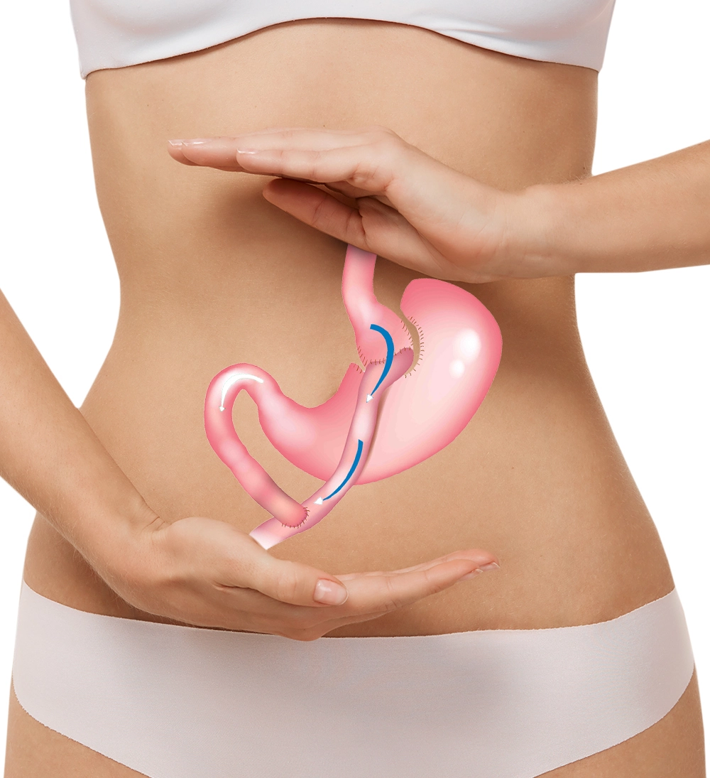  Image representing problems to be solved with gastric bypass in Shape Surgery.